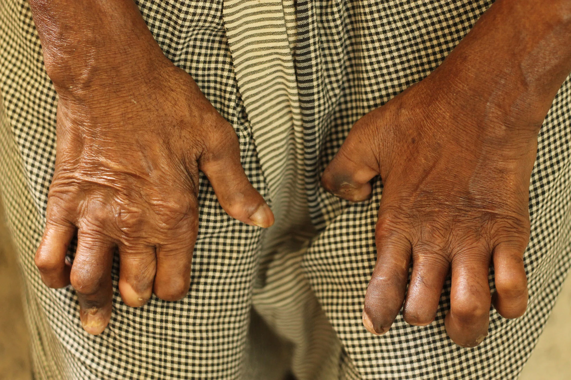 16 districts of Nepal yet to be leprosy free